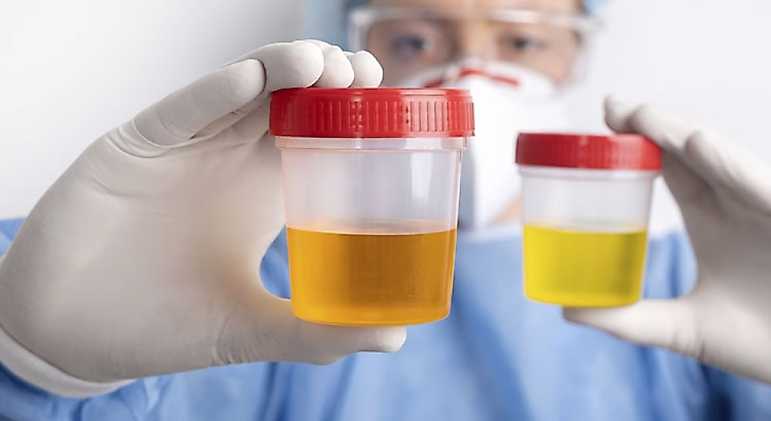 I contenitori sterili per la raccolta delle urine